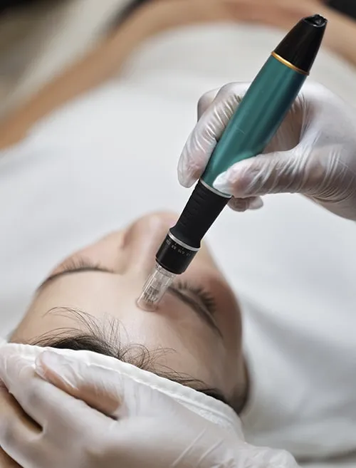 Imagem Microagulhamento com tunelização dérmica